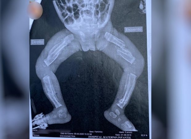 Morre bebê de 6 meses que era agredido por pais&nbsp;maranhenses