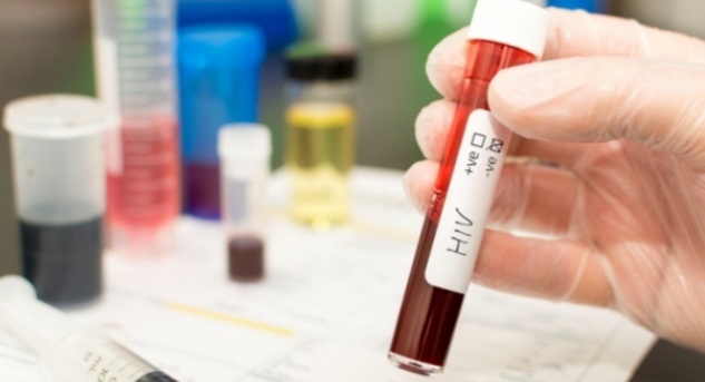 Pesquisa indica risco de monkeypox agravar infeccão por&nbsp;HIV