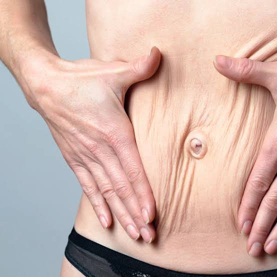 Fiz bariátrica, e agora? Mudanças no corpo após procedimento podem, ou não, exigir outra cirurgia;&nbsp;entenda