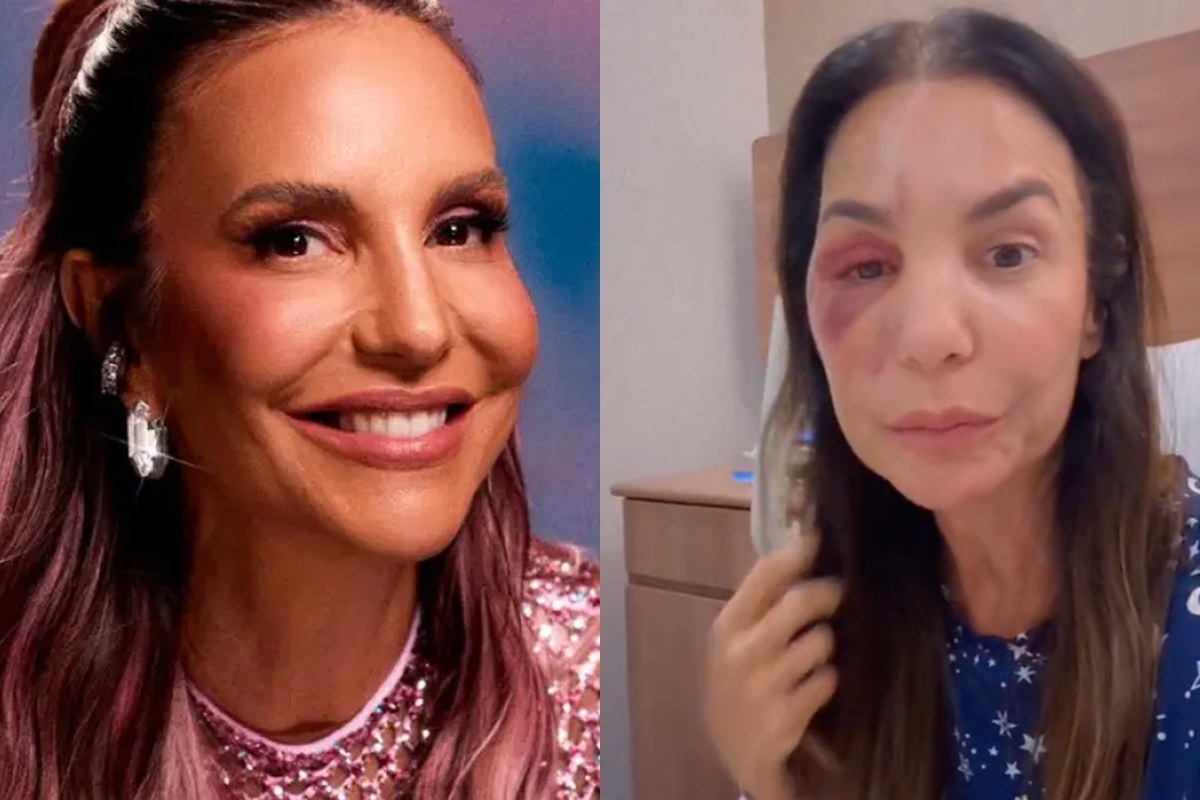 Ivete Sangalo mostra rosto com hematoma e atualiza estado de saúde